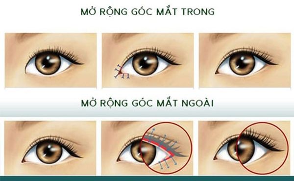MỞ RỘNG GÓC MẮT