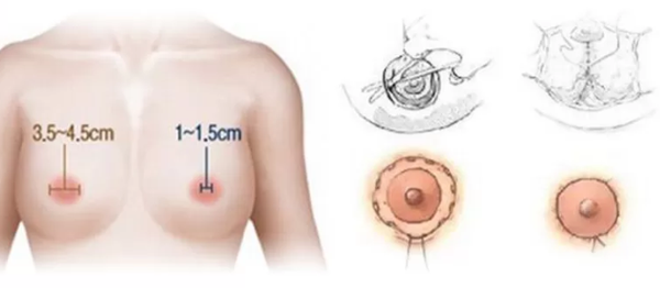 THU GỌN QUẦNG VÚ