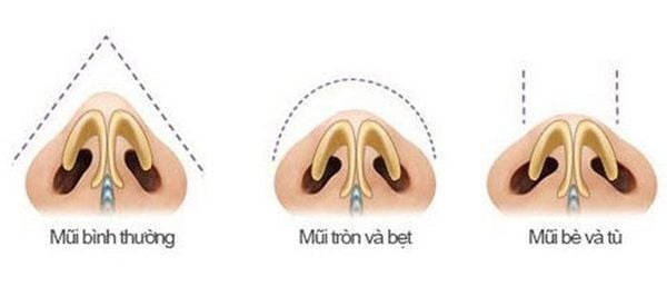 THU GỌN ĐẦU MŨI