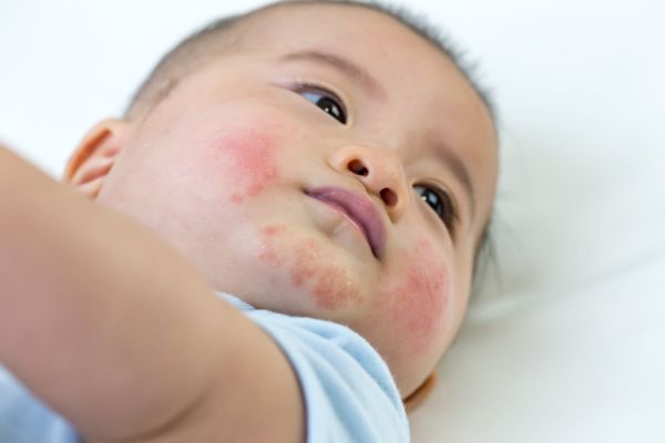 Da của bé không hợp sữa công thức có thể nổi mẩn đỏ