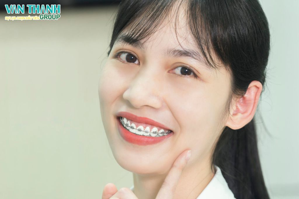 Vì sao niềng răng mắc cài được ưu chuộng?