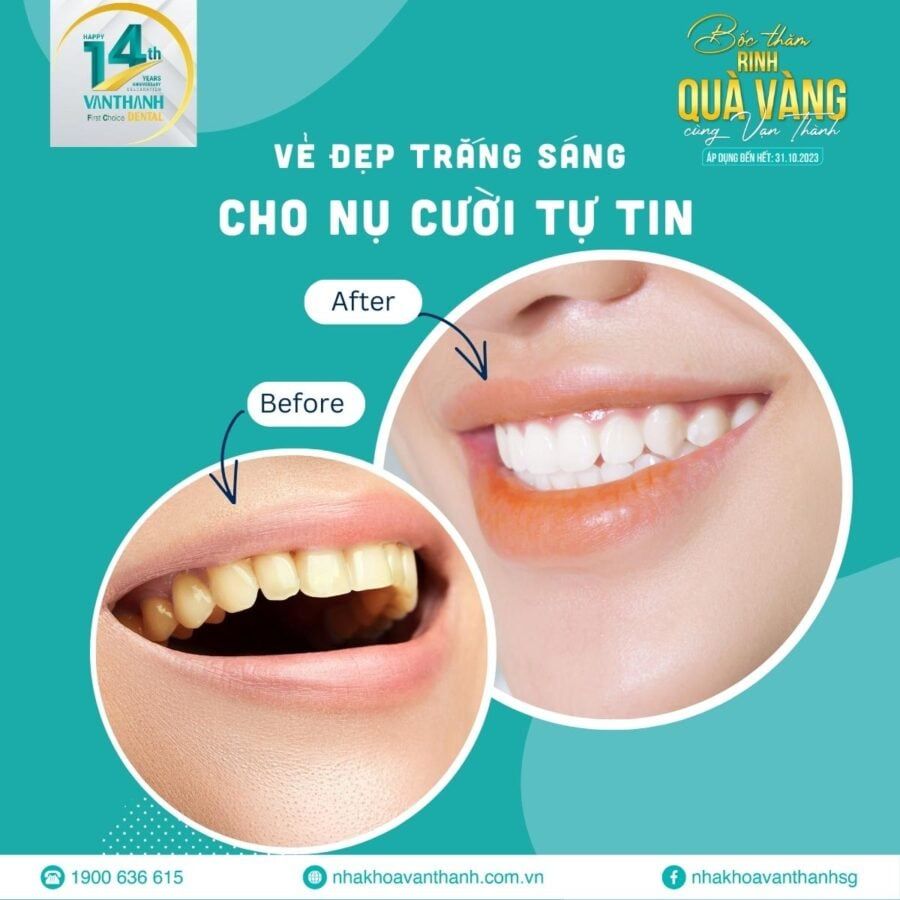 Tạm biệt răng ố vàng gọn gàng 20 phút