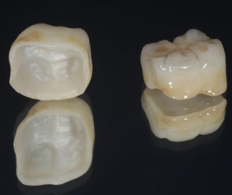 Thời điểm phù hợp để phục hình răng sứ – Bạn cần biết!