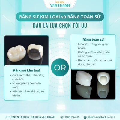 Răng sứ kim loại hay răng sứ toàn sứ – Nên chọn loại nào tốt hơn?