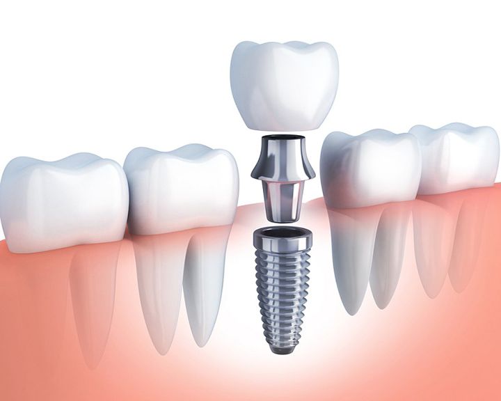 “Biết tuốt” về Implant
