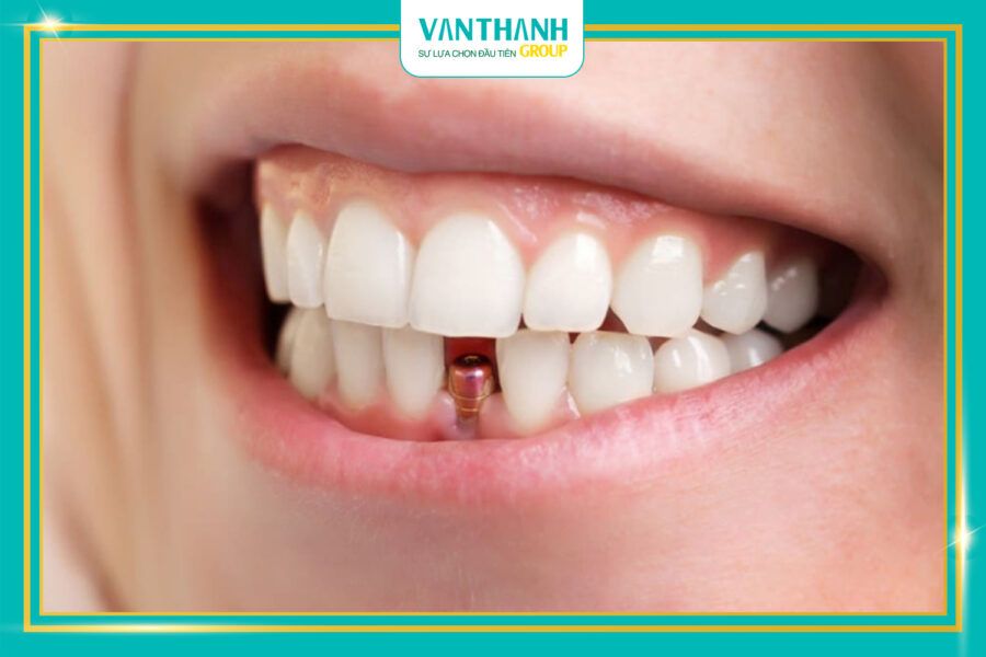 Implant giá rẻ, tiền mất tật mang!