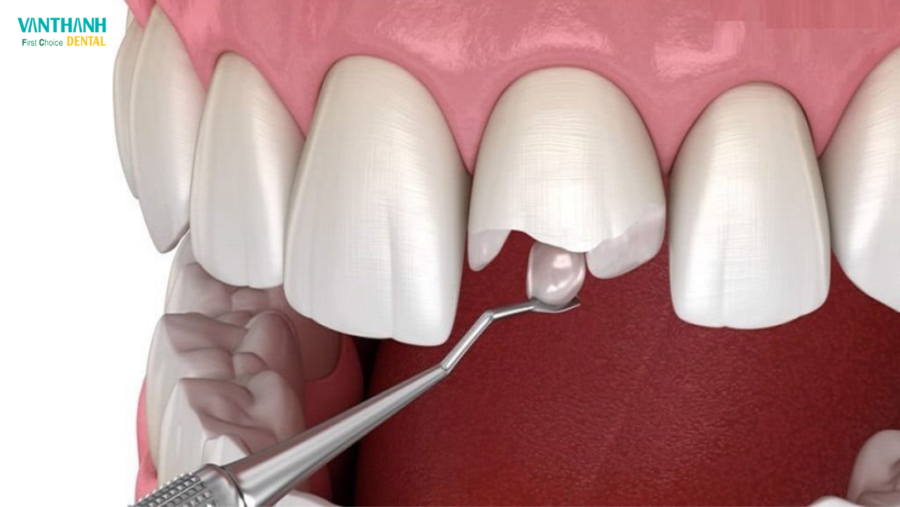 ĐỘ BỀN CỦA TRÁM RĂNG COMPOSITE LÀ BAO LÂU?