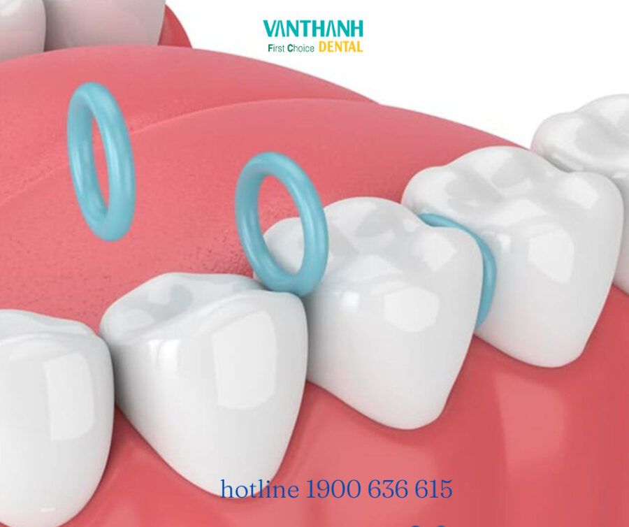 KINH NGHIỆM GIÚP GIẢM ĐAU KHI ĐẶT THUN TÁCH KẼ