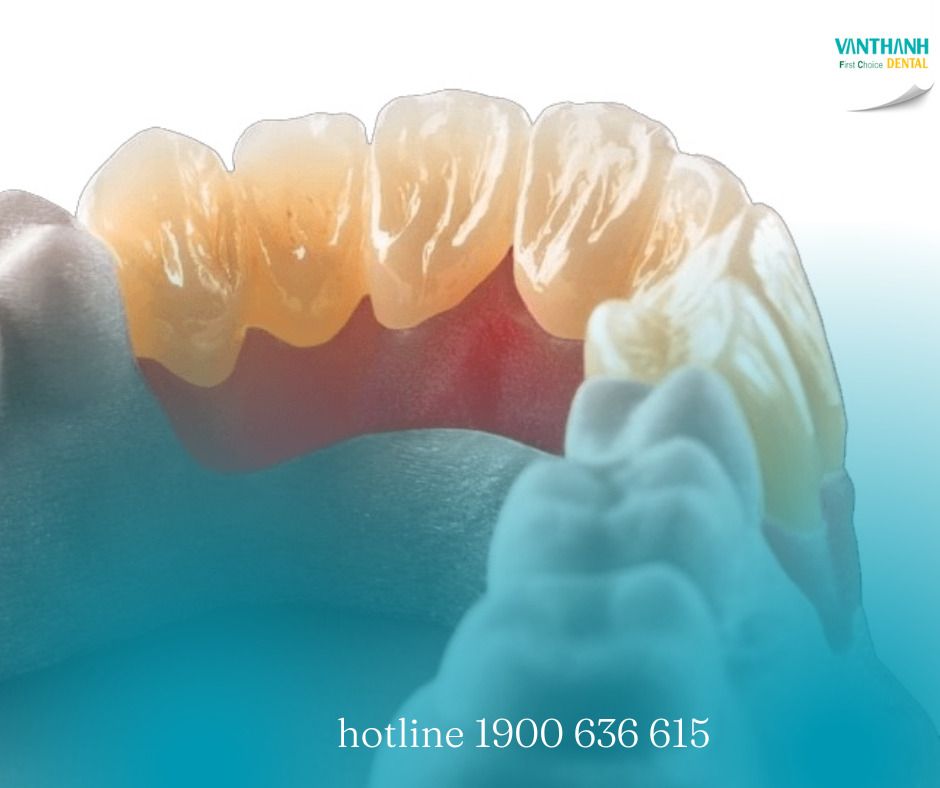 RĂNG SỨ DDBIO LÀ GÌ? ƯU NHƯỢC ĐIỂM & GIÁ CẢ