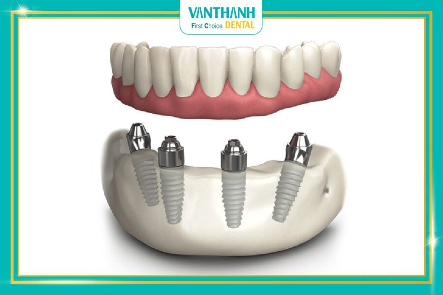 Implant toàn hàm - Giải pháp tối ưu chi phí