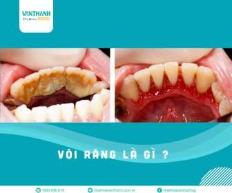 Vôi răng và top 5 tác hại nguy hiểm