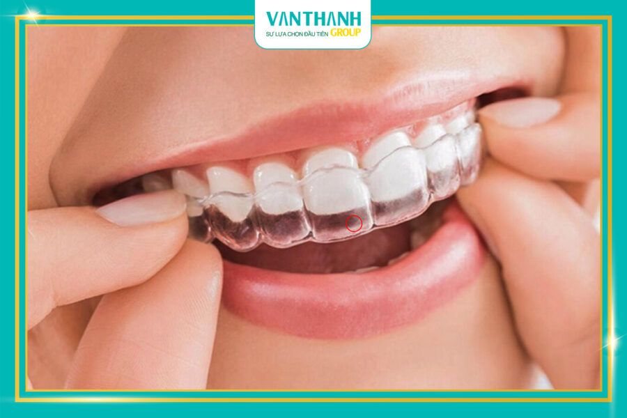 Niềng răng giá rẻ, hậu quả khôn lường!