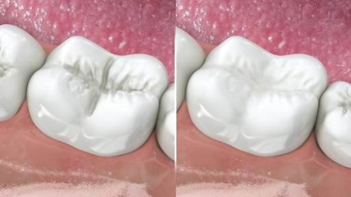 Điều trị sâu răng thế nào?