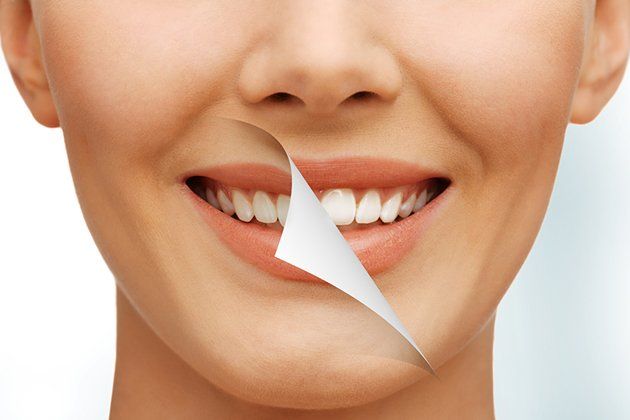 Tẩy trắng răng ố vàng hiệu quả thế nào?