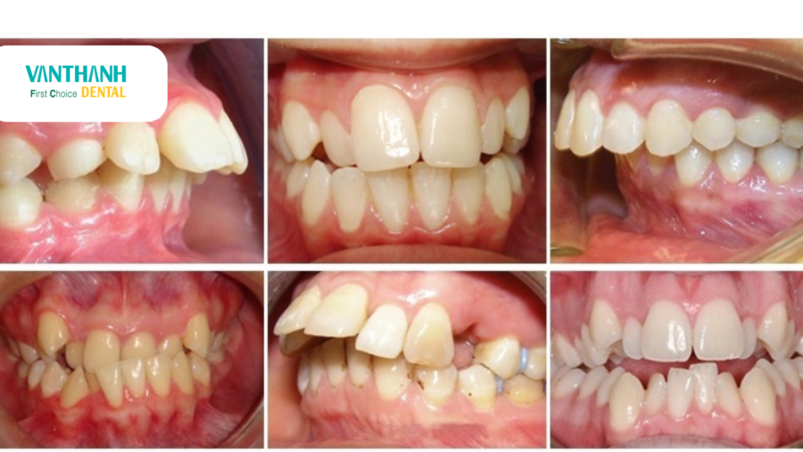 BỊ LỆCH KHỚP CẮN NÊN NIỀNG RĂNG BẰNG MẮC CÀI SỨ HAY TRỒNG RĂNG IMPLANT?