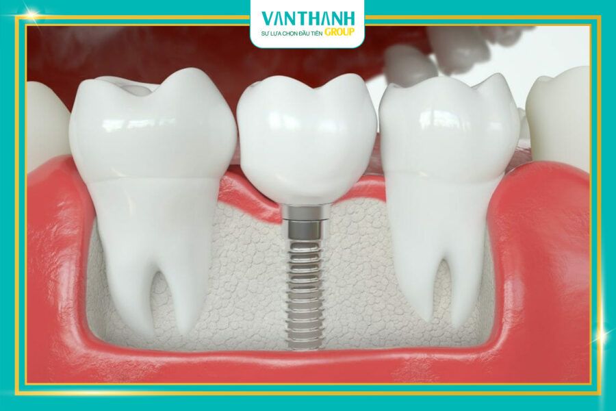 Răng sứ trên Implant nên chọn loại nào thì tốt?
