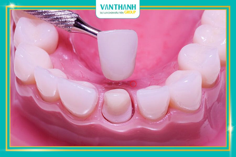 Răng tạm là gì? Khi nào cần bạn cần sử dụng chúng?