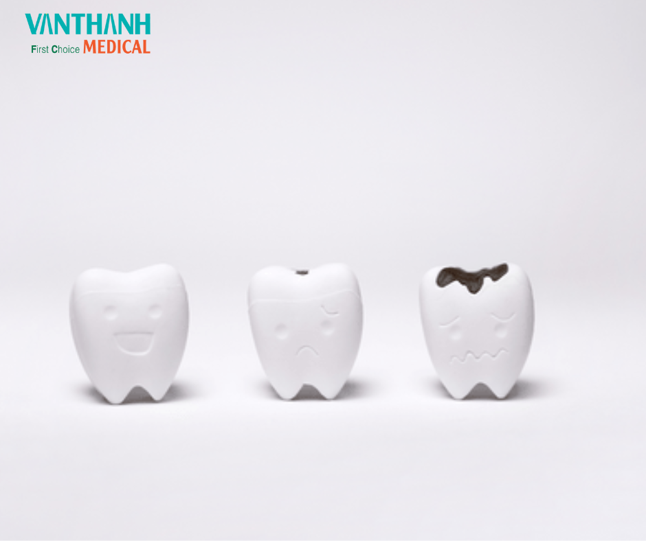 BẬT MÍ CON SÂU RĂNG CÓ THẬT KHÔNG?