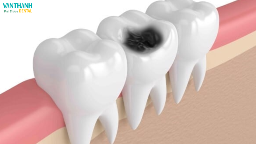 NẾU RĂNG KHÔNG PHẢI LÀ XƯƠNG, THÌ CHÚNG ĐƯỢC LÀM BẰNG CÁI GÌ!?