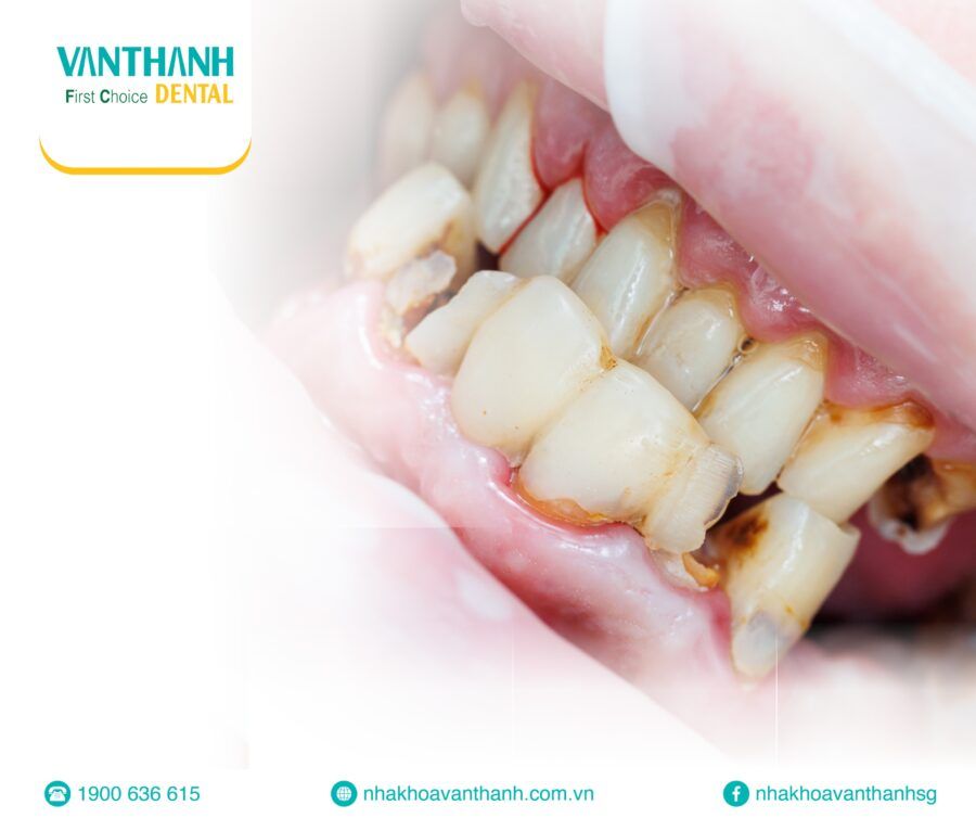 Răng sáng cười xinh, Vui đón giáng sinh