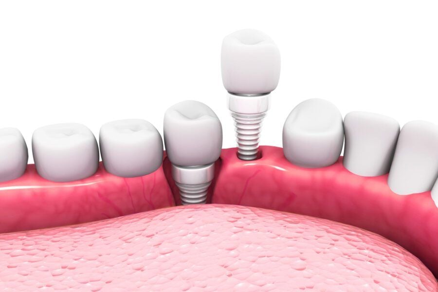 Đừng cắm Implant nếu bạn chưa biết điều này!