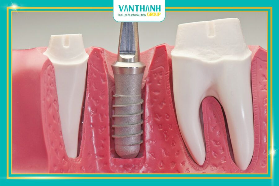 Độ bền Implant cao nhất từng được ghi nhận là bao lâu?