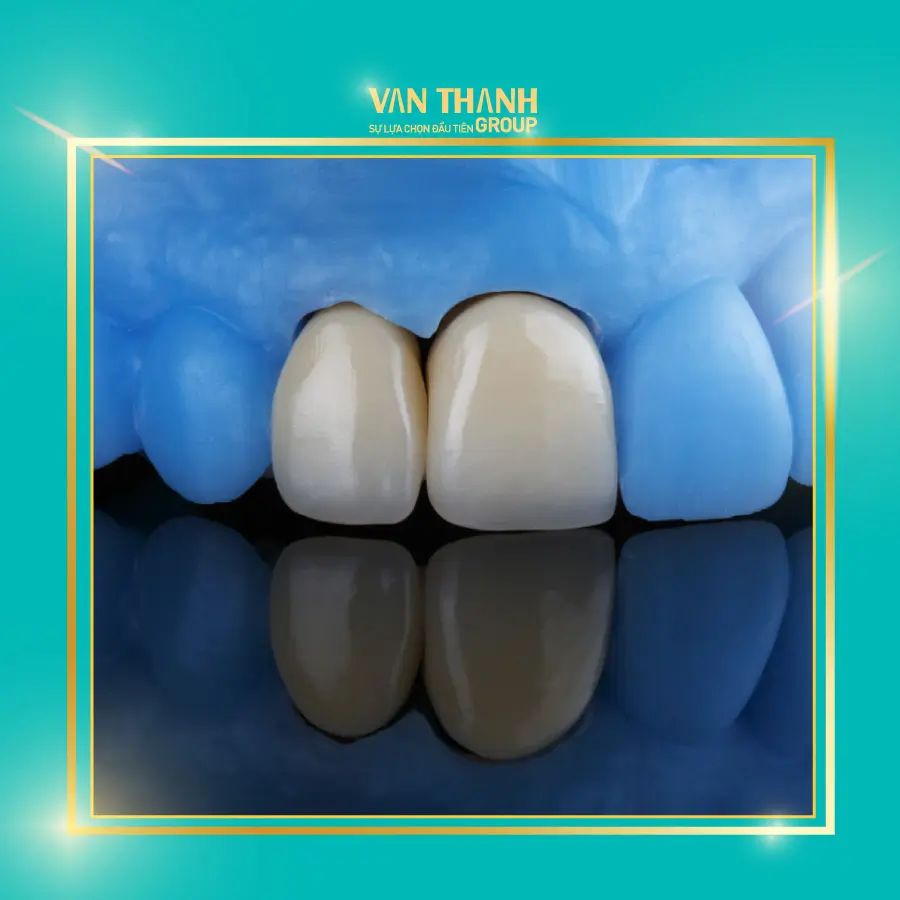 HÈ YÊU THƯƠNG - RĂNG SỨ CHẤT LƯỢNG