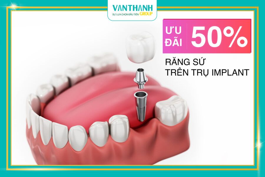 Đến nha khoa Vạn Thành nhận quà tặng tháng 7!