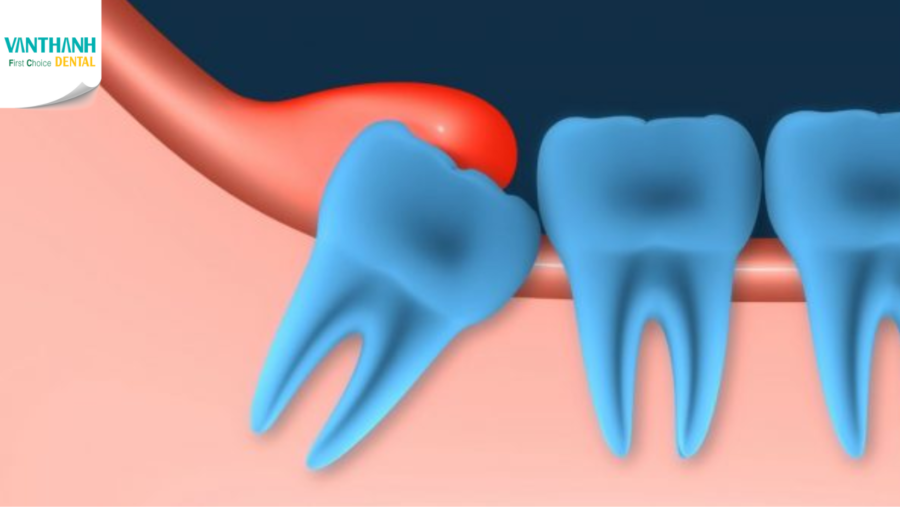 Viêm lợi trùm răng khôn khi mang thai có ảnh hưởng thai nhi không?