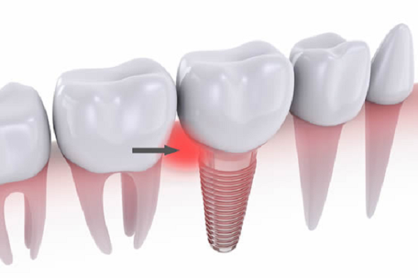Viêm quanh Implant do đâu?