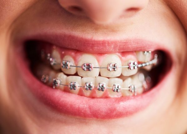 quy trình niềng răng mắc cài kim loại