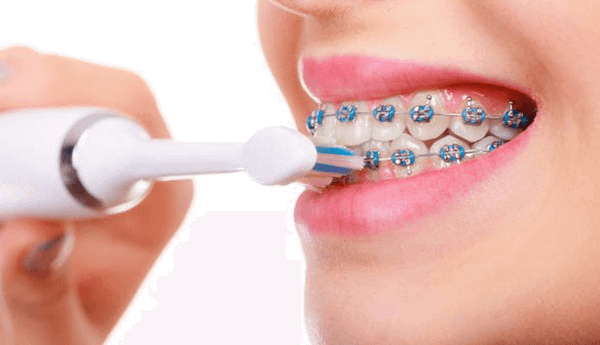 quy trình niềng răng mắc cài kim loại