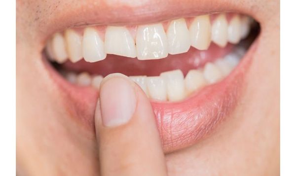 dán răng veneer là gì ?