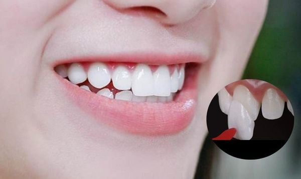 veneer răng thỏ