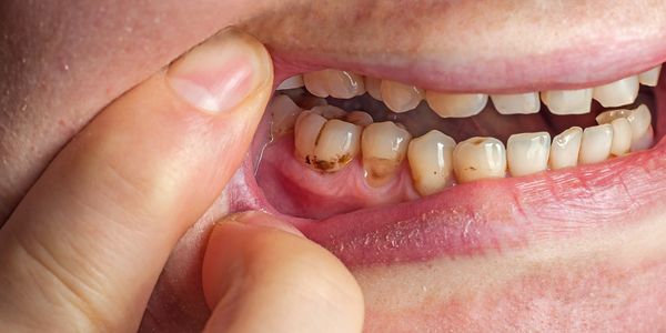 lấy cao răng là gì ? Có nên đi lấy cao răng không