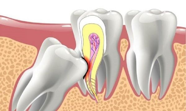 nhổ răng khôn mọc lệch có đau không