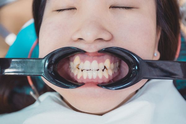 niềng răng là gì - quy trình niềng răng