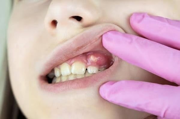 viêm nha chu là gì