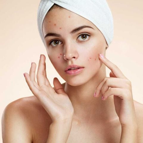 Laser Cho Thâm Sau Mụn: Đánh Giá Và Những Lưu Ý