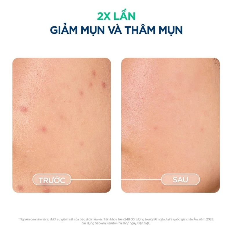 Kem Dưỡng Hỗ Trợ Cải Thiện Mụn & Mờ Thâm Bioderma Sebium Kerato+ 30ml