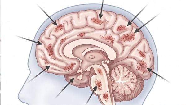 Tìm Hiểu Về Hội Chứng CTE (Chấn Thương Não Mạn Tính) Và Cách Phòng Tập Bảo Vệ Học Viên