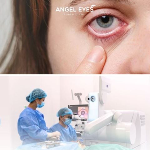Mổ Mắt Xong Có Được Đeo Lens Không? Tư Vấn Từ Chuyên Gia