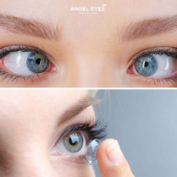 Mắt Lác Có Đeo Lens Được Không? Giải Đáp Từ Chuyên Gia