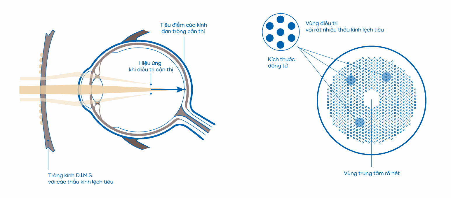 Tròng Kính Kiểm Soát Tiến Triển Cận Thị Trẻ Em Hoya Miyosmart Full Control 1.59