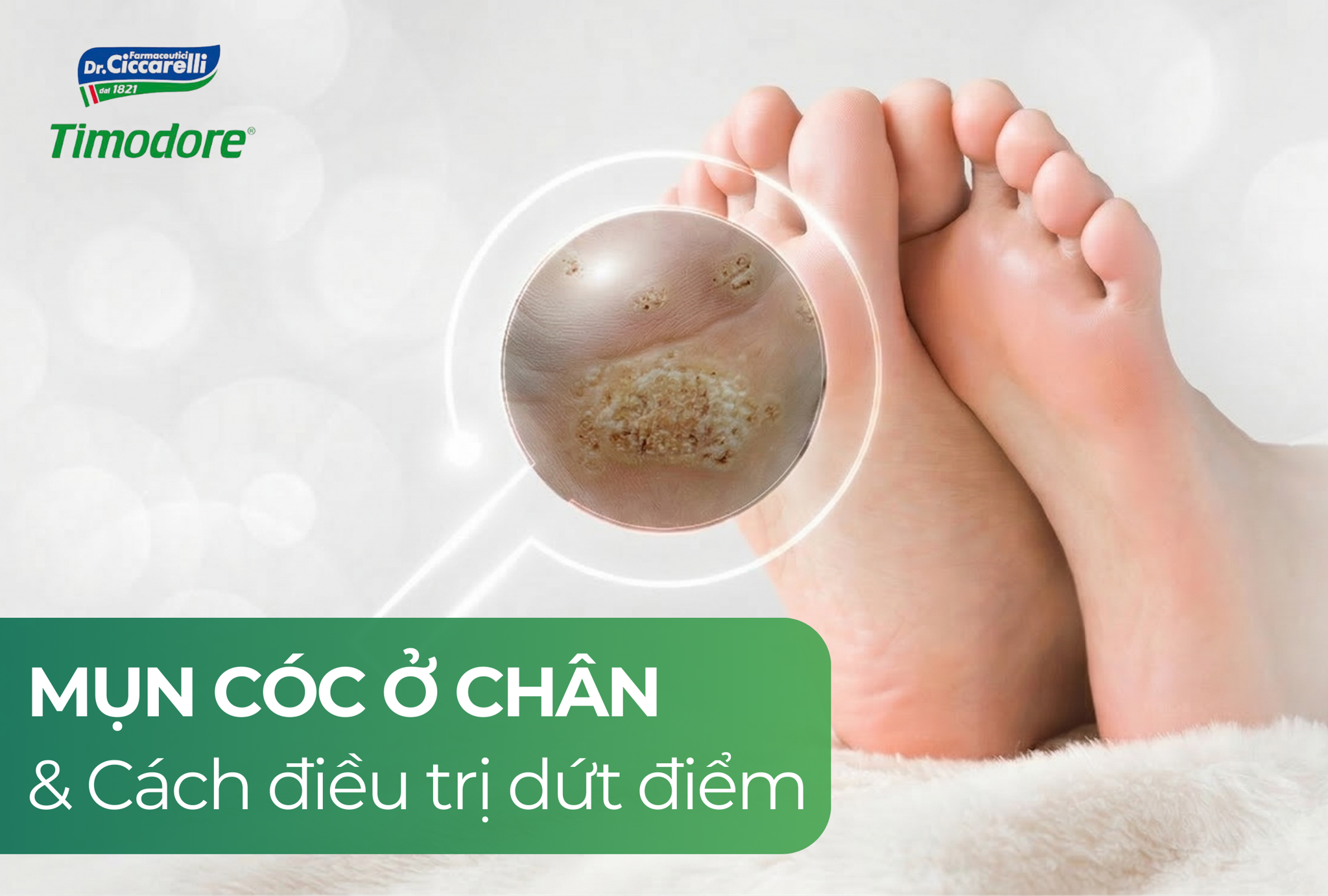 Mụn cóc ở chân: Cẩm nang toàn diện và cách xử lý hiệu quả tại nhà không để lại sẹo