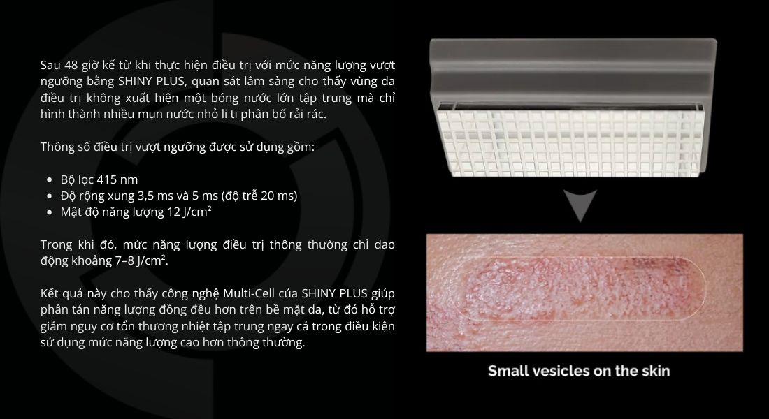 may-ipl-SHINY-PLUS-2