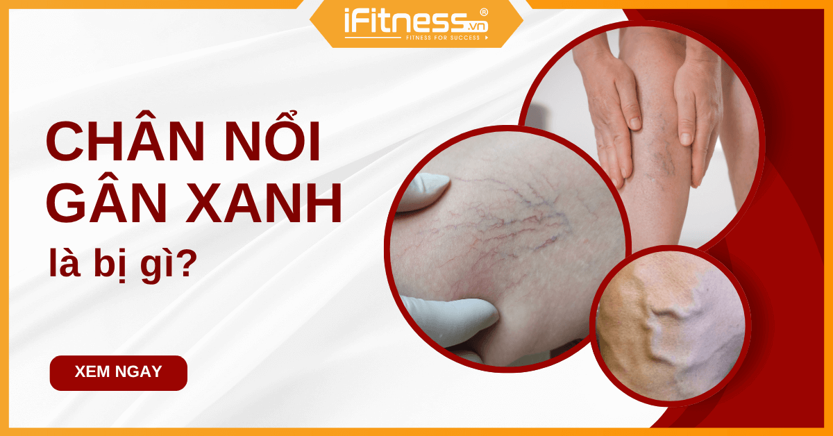 Chân nổi gân xanh là bị gì? Đừng chủ quan với bệnh lý nguy hiểm này!