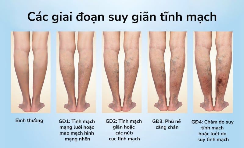Bệnh suy giãn tĩnh mạch là gì?