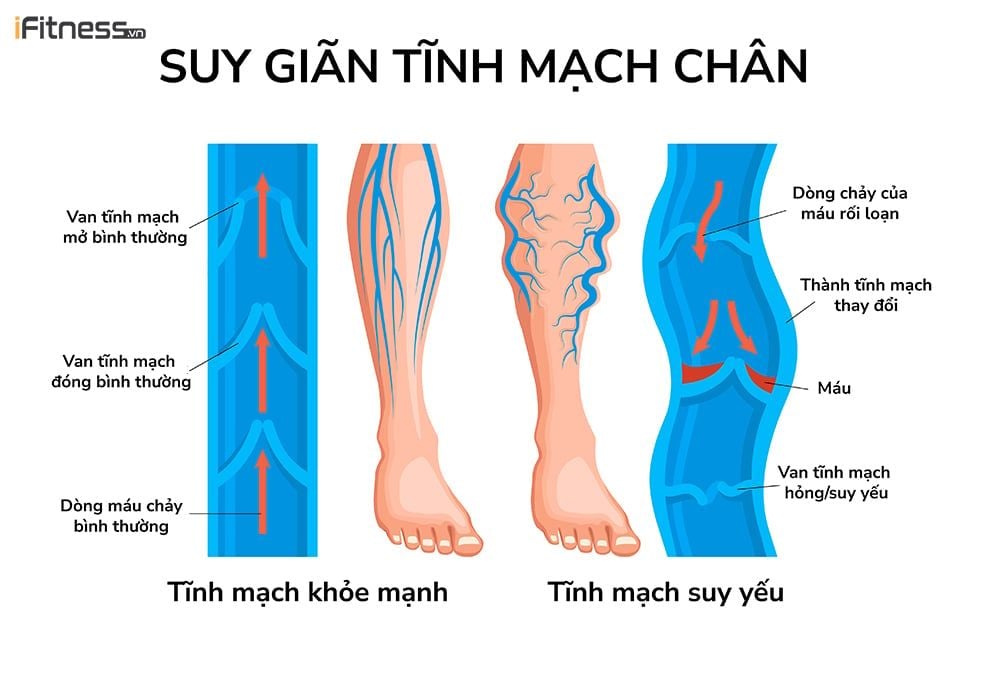 Bệnh suy giãn tĩnh mạch là gì?