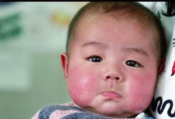 Chăm sóc da bé bị nẻ mùa khô: Đơn giản mà hiệu quả nhanh chóng